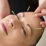 A acupuntura é uma técnica terapêutica da medicina tradicional chinesa - Acupuntura - Flickr Cosmetic Acupuncture