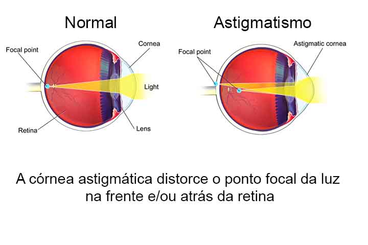 Os erros de refração, como miopia, hipermetropia, astigmatismo e presbiopia, também são causas comuns de problemas visuais. Eles ocorrem quando a luz não é corretamente focada na retina, resultando em visão embaçada. O tratamento inclui o uso de óculos ou lentes de contato e, em alguns casos, cirurgia refrativa para corrigir o problema. -   BruceBlaus/Wikimédia Commons
