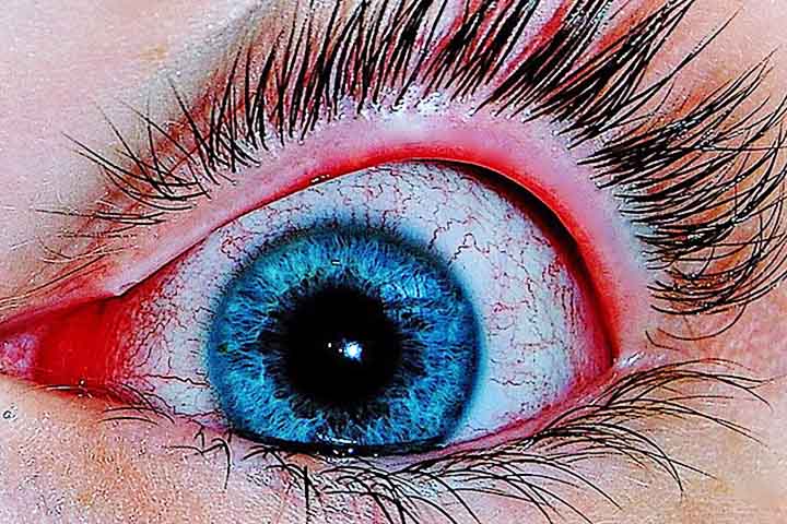 Os sintomas incluem vermelhidão, coceira, inchaço das pálpebras e sensação de corpo estranho nos olhos. O tratamento varia conforme a causa da inflamação e pode incluir colírios antibióticos ou anti-inflamatórios. - Joyhill09/Wikimédia Commons