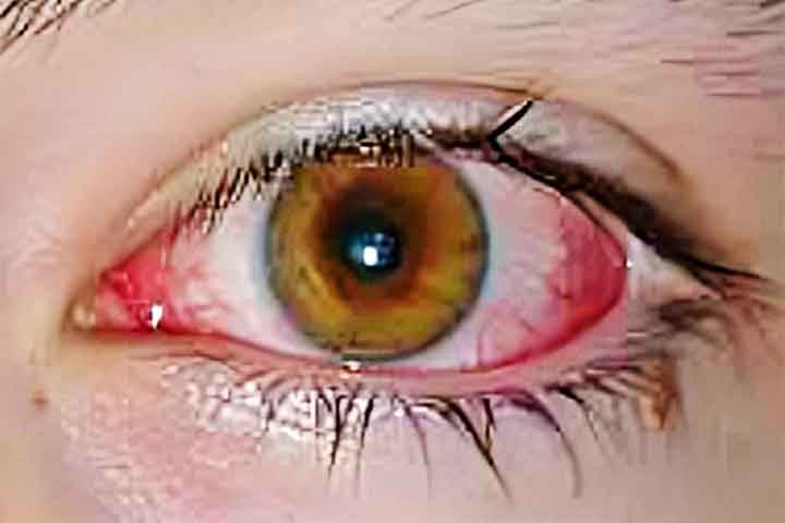 Já a conjuntivite é uma inflamação da membrana que reveste a parte anterior do olho e pode ser causada por infecções virais ou bacterianas, alergias ou substâncias químicas irritantes. -  BrandonR/Wikimédia Commons