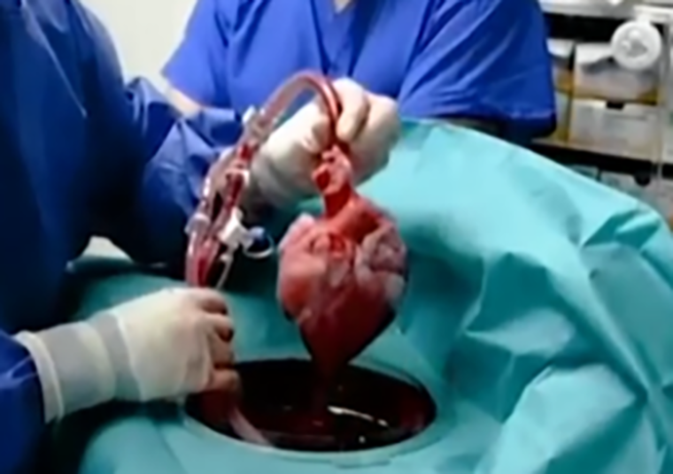 Inacreditável! Homem recebe coração de porco e cirurgia dá certo!