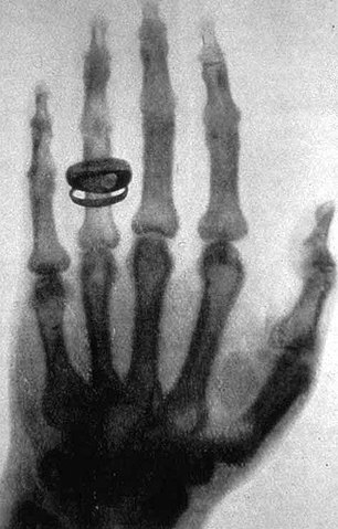 Dentre as primeiras experiências com a radiação eletromagnética, está a radiografia da mão de Albert con Kölliker, amigo de Röntgen. 