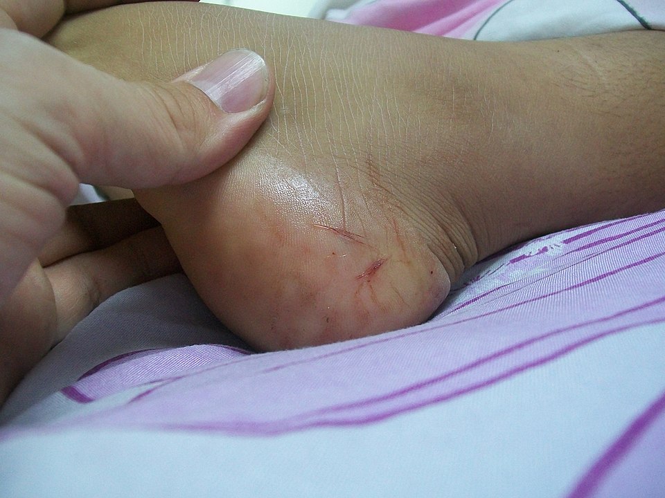Em caso de mordida de cobra, não use torniquete, pois há risco de necrose e até amputação. Não se deve cortar o local, fazer perfurações ou sucção; o local da picada deve ser lavado com água e sabão; a vítima deve ser levada o mais rápido possível ao hospital.