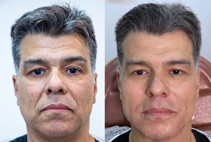 harmonização facial