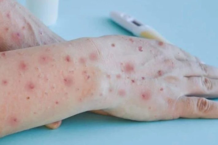 Mpox – Divulgação/OMS