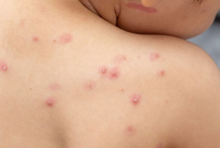 Mpox