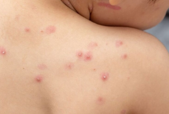 Mpox – Divulgação/Ministério da Saúde