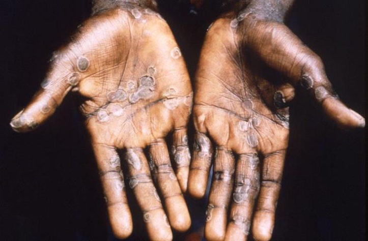 Mpox 