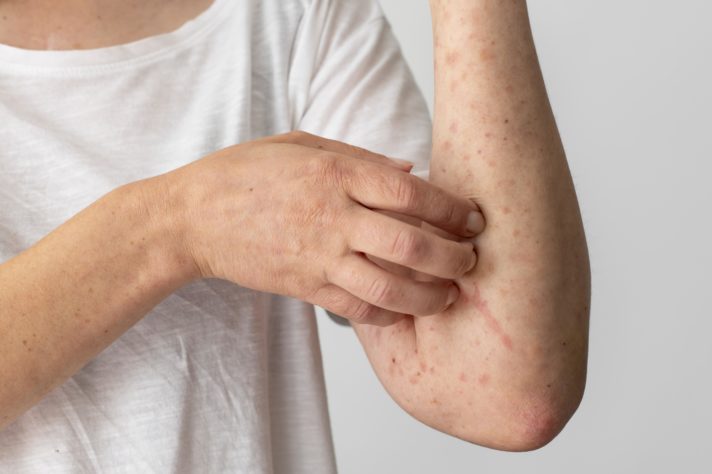 Mpox
