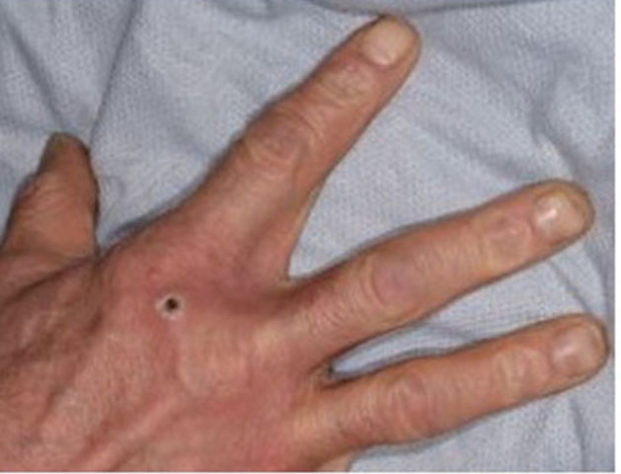 Mpox – Divulgação/Agência de Segurança da Saúde do Reino Unido