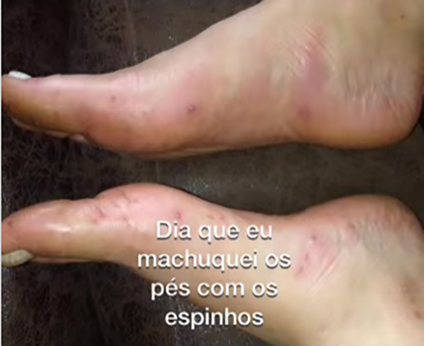 Gabriela passou pomada, álcool, desinfetou os pés, e achou que estaria tudo bem. -Reprodução Instagram