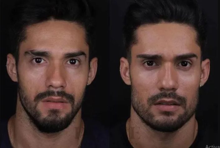 harmonização facial