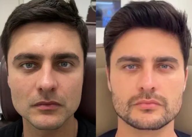 harmonização facial