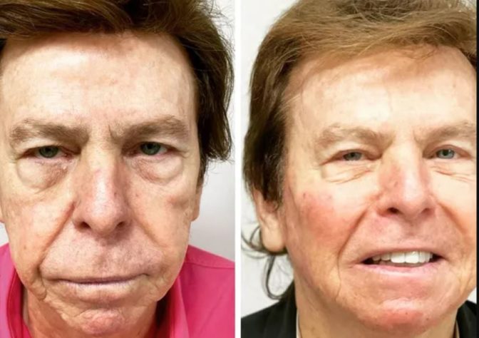 harmonização facial