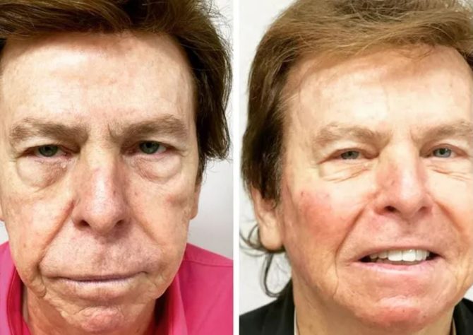 Nelson Rubens Harmonização Facial - Reprodução/Redes Sociais
