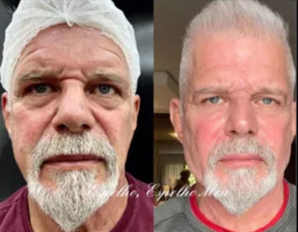 harmonização facial