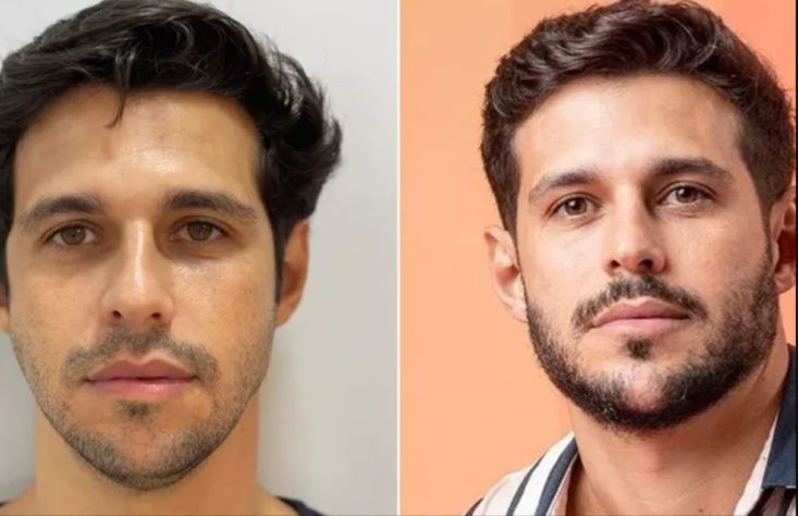 harmonização facial