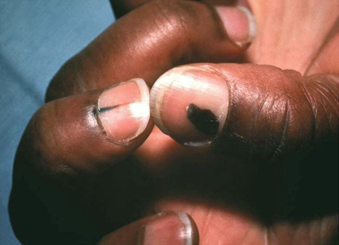O melanoma Acral Lentiginoso Ã© o mais comum em pessoas de pele negra ou asiÃ¡tica. E Ã© o menos comum em pessoas de pele branca. Ele Ã© traiÃ§oeiro, pois pode surgir embaixo da unha, sem que as pessoas percebam. JÃ¡ o melanoma lentigo maligno acomete mais os idosos e Ã© o mais ligado Ã  exposiÃ§Ã£o solar ao longo da vida. 