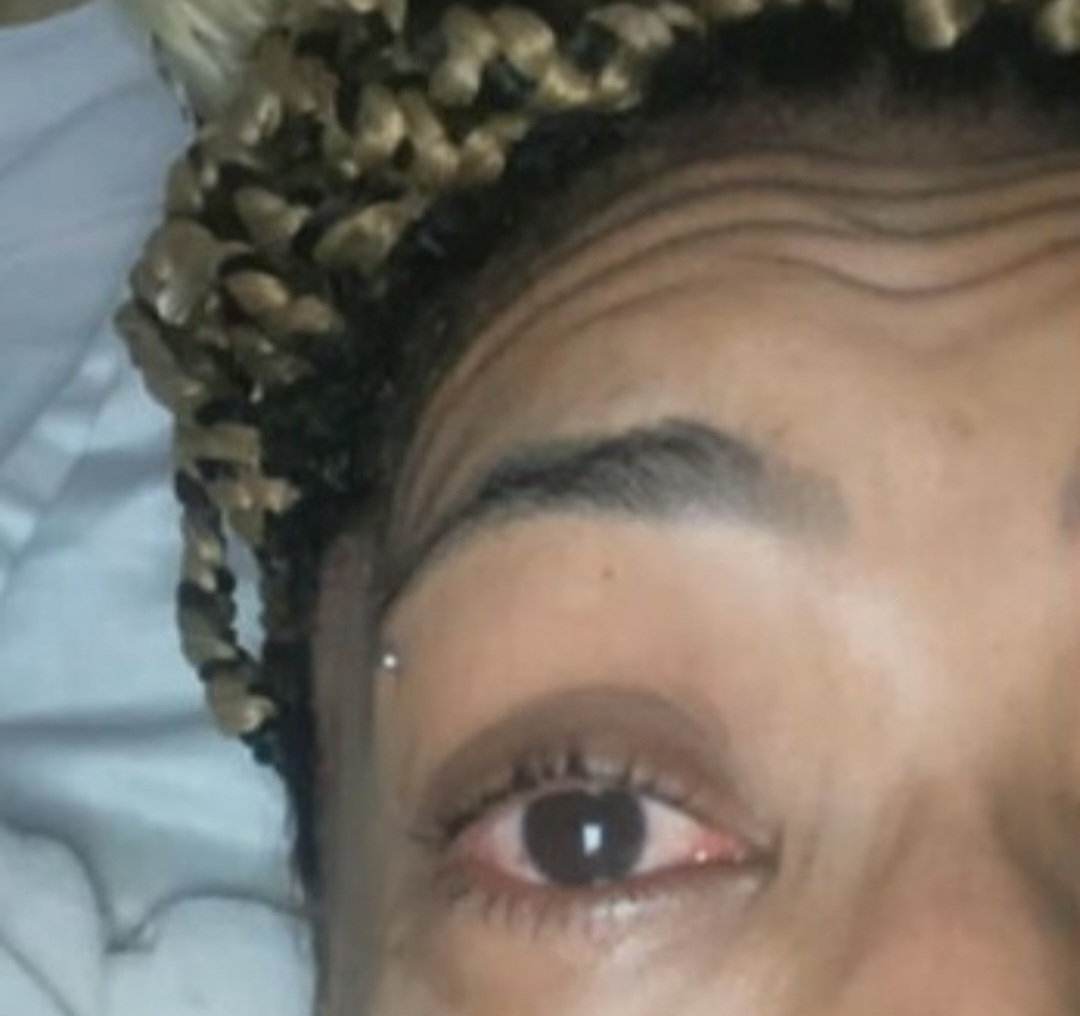 <p>Com o boom de ocorrências negativas, a Anvisa programou fiscalizações para identificar pomadas que tivessem efeito nocivo para os olhos. </p>
