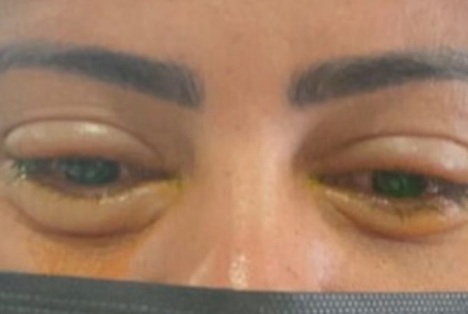 Com o carnaval, Anvisa faz novo alerta sobre perigo das pomadas de cabelo