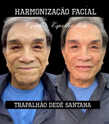harmonização facial