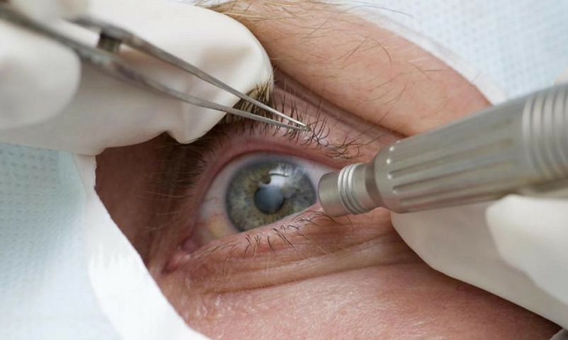 A catarata pode ser tratada por meio de cirurgia, um procedimento seguro e eficaz que consiste na remoção do cristalino opaco e sua substituição por uma lente intraocular artificial.