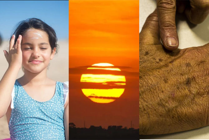 Sol e calor: Saiba se proteger do câncer de pele