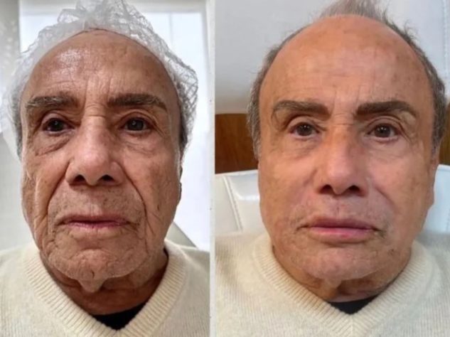 harmonização facial