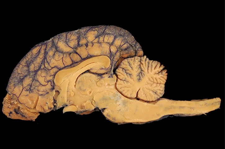  A demência, na verdade, é um nome genérico dado a um grupo de doenças cerebrais, que, se não forem tratadas, levam à morte. As doenças costumam afetar algumas funções cerebrais, mas não a consciência da pessoa.-- Dominio Publico/hippopx.com