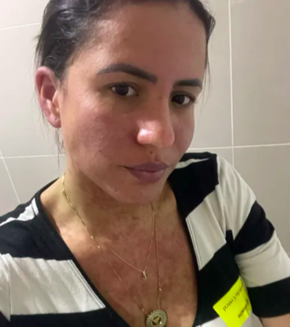 Mulher do cantor Frank Aguiar passou 10 dias internada com doença rara que queima a pele