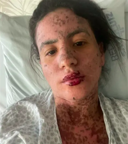 Mulher do cantor Frank Aguiar passou 10 dias internada com doença rara que queima a pele