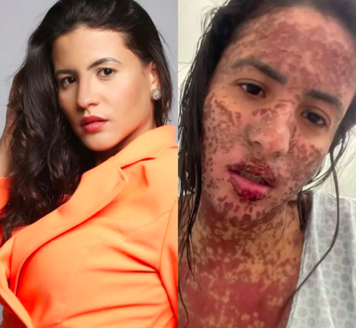 Mulher do cantor Frank Aguiar passou 10 dias internada com doença rara que queima a pele