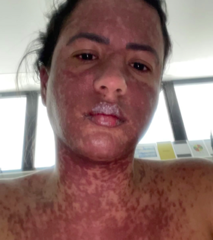 Mulher do cantor Frank Aguiar passou 10 dias internada com doença rara que queima a pele