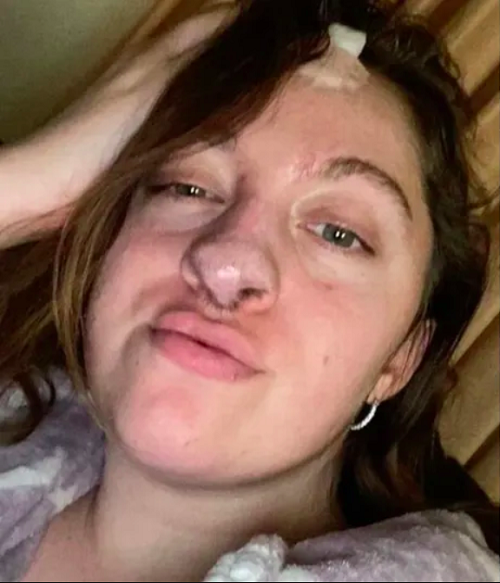 Outras razões para recorrer a um enxerto são quando a cicatrização é demorada, há muitas dores, aspecto estético deformado e risco de contaminação. Mas como são feitos os enxertos?