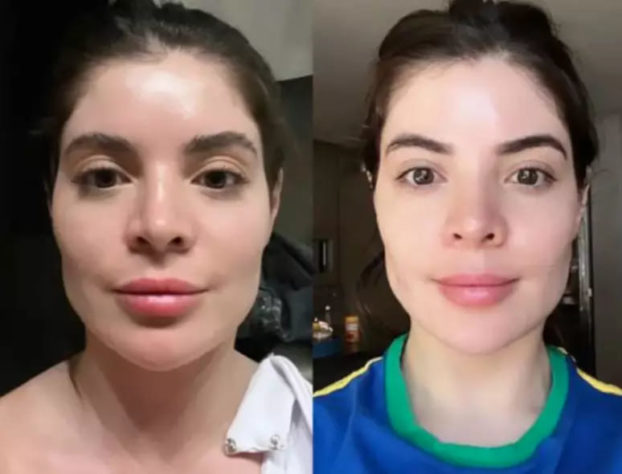 harmonização facial