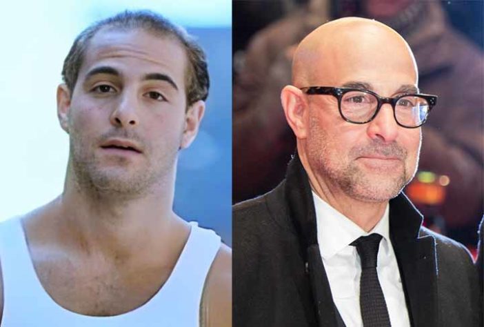 Atores famosos que ficaram carecas