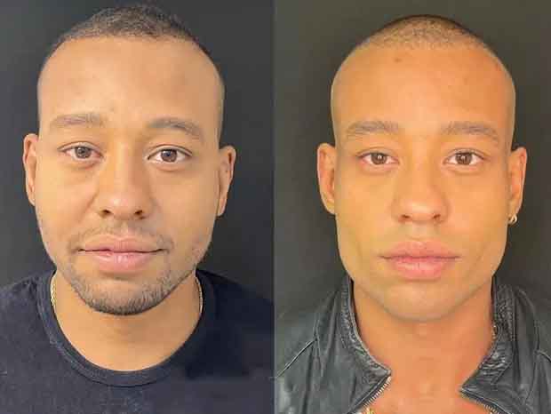 harmonização facial