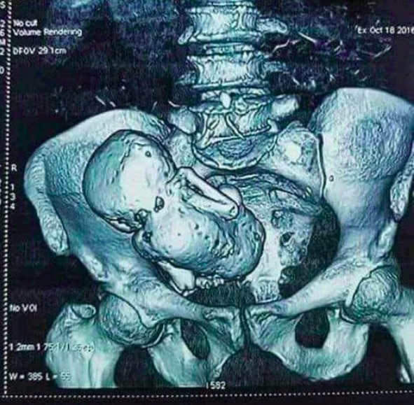Essa não é a primeira vez que um caso desse tipo acontece no Brasil. Em 2023, se tornou viral nas redes sociais a história de uma senhora de 84 anos do interior do Tocantins, que descobriu que havia um feto calcificado de sete meses em seu corpo por mais de 40 anos.