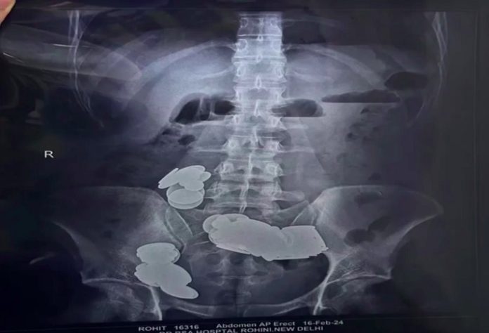 Homem engole moedas e imãs na Índia