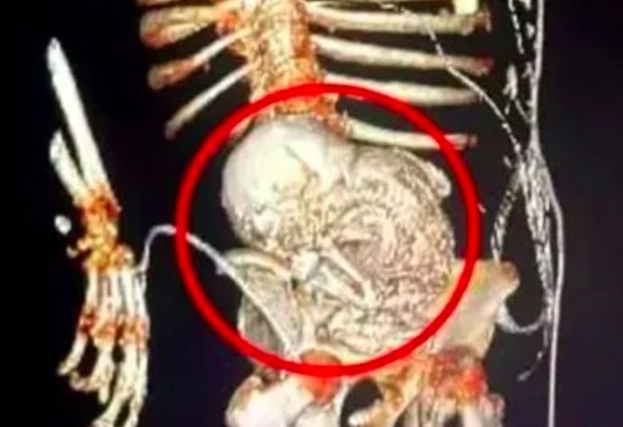 Idosa morre após fazer cirurgia para retirar bebê calcificado há 56 anos 