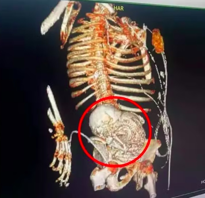 â??Normalmente a mulher nÃ£o apresenta sintomas, por isso essa condiÃ§Ã£o acaba sendo diagnosticada por acaso somente anos depois da gravidezâ?, disse a obstetriz.