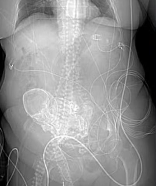 Litopédio se caracteriza pelo óbito de um feto durante a gravidez, seguido pela calcificação dele dentro do abdômen da mulher.