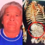 Montagem - Idosa morre após fazer cirurgia para retirar bebê calcificado há 56 anos