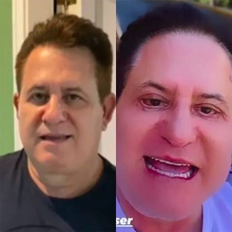 Marrone realiza procedimento estético no rosto - Montagem/Reprodução