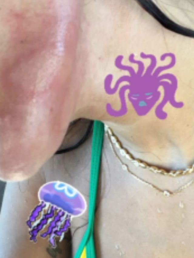 Animal que ‘queimou’ Anitta prolifera no sul do Brasil