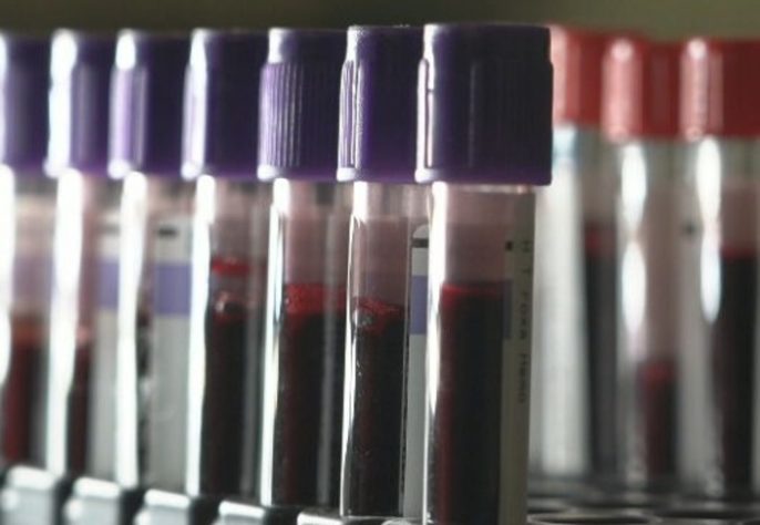 Transplante de órgãos de pessoas com HIV aids RJ