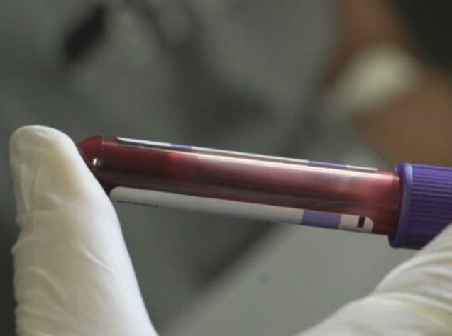 Transplante de órgãos de pessoas com HIV aids RJ