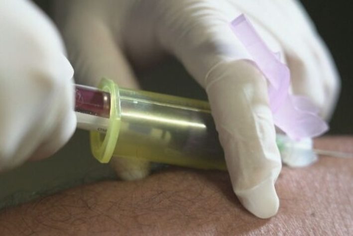 Transplante de órgãos de pessoas com HIV aids RJ