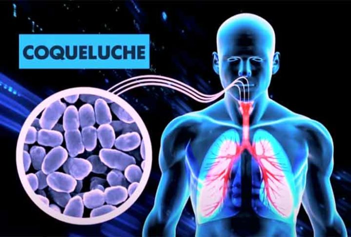 Coqueluche