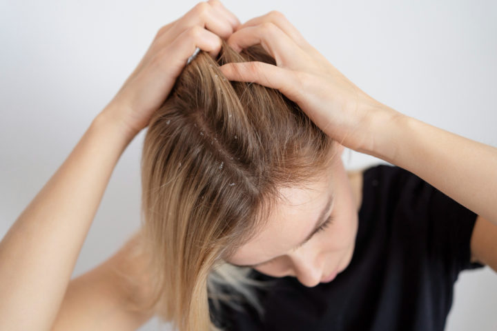 O método mais comum de transmissão é por meio do contato direto com o cabelo (ou cabeça) de uma pessoa infestada.